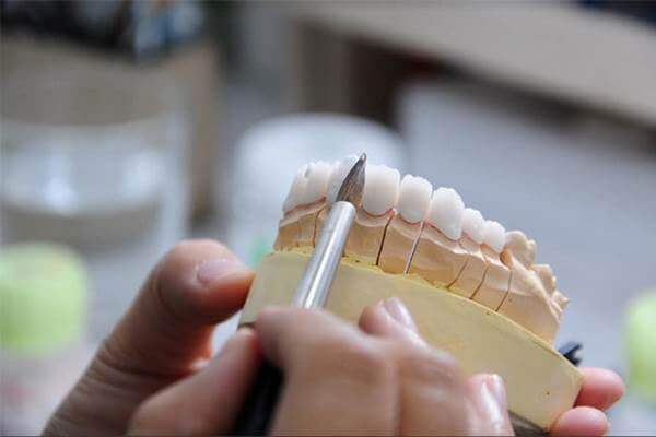 kỹ thuật phục hình răng